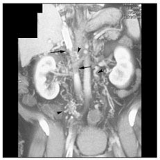 IVC thrombosis:Bland thrombus